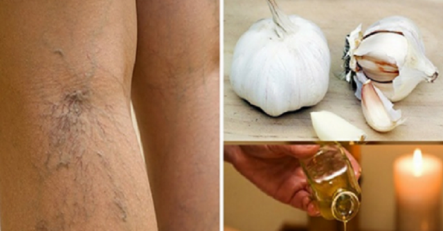 Отървете се от разширените вени с натурални средства!